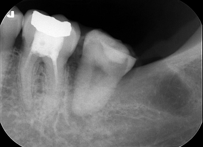 歯の移植直後　左下の親知らずを左下の７番目の歯に移植。移植直後のパノラマX線写真とデンタルＸ線写真。